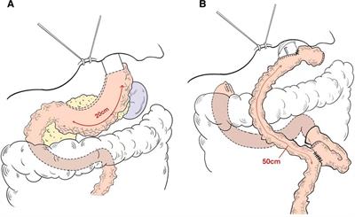 Clinical outcomes of proximal gastrectomy with gastric tubular reconstruction and total gastrectomy for proximal gastric cancer: A matched cohort study